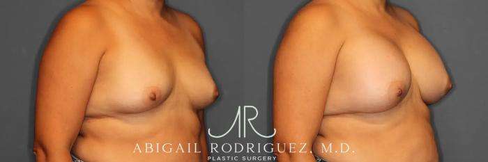 Before & After Breast Augmentation Case 259317 View 5 View in Houston, TX