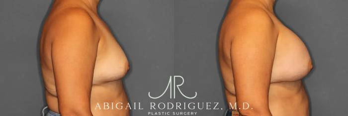 Before & After Breast Augmentation Case 259317 View 6 View in Houston, TX