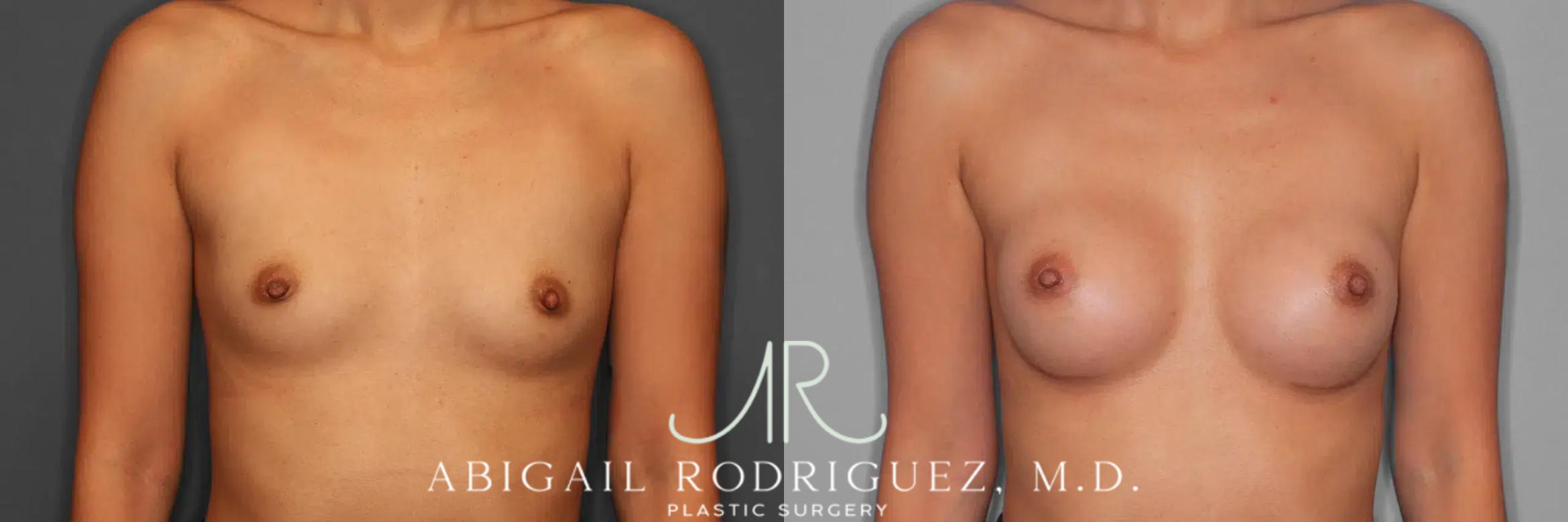 Before & After Breast Augmentation Case 259326 View 1 View in Houston, TX