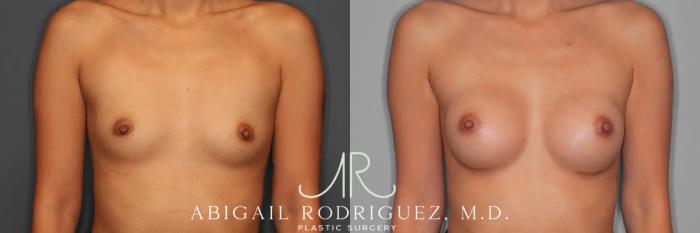 Before & After Breast Augmentation Case 259326 View 1 View in Houston, TX