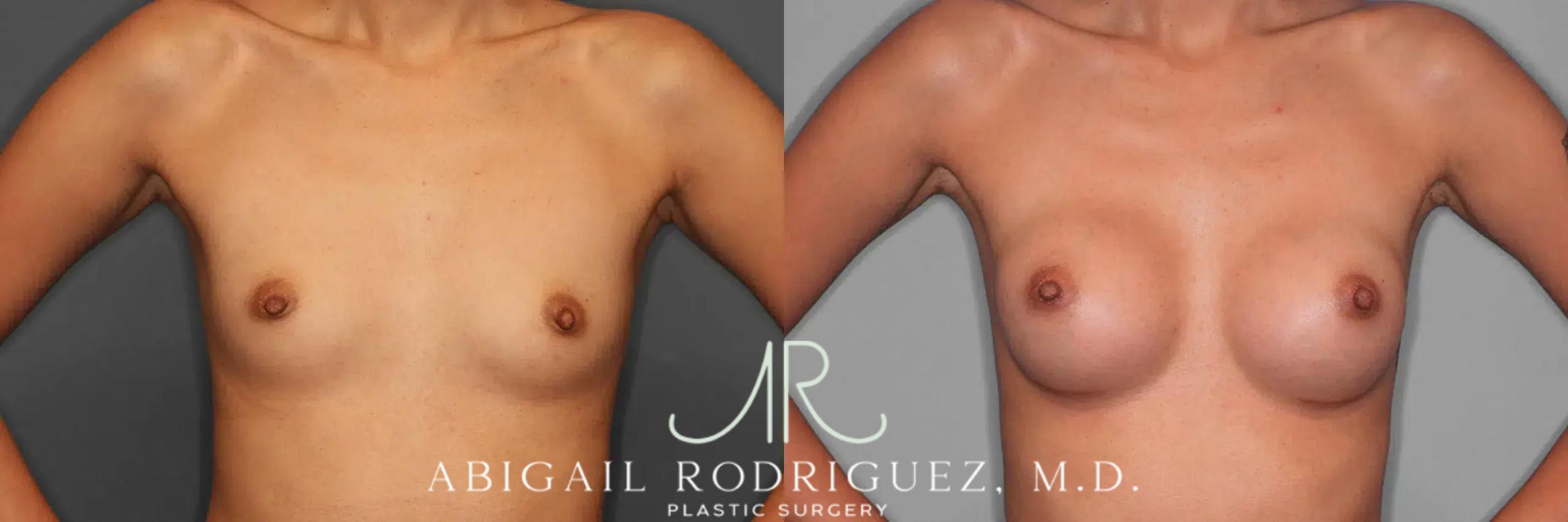 Before & After Breast Augmentation Case 259326 View 2 View in Houston, TX