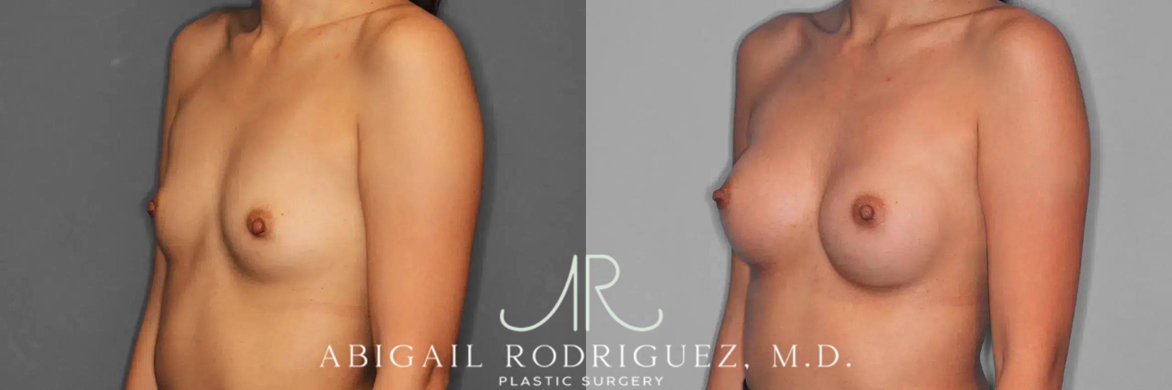 Before & After Breast Augmentation Case 259326 View 3 View in Houston, TX