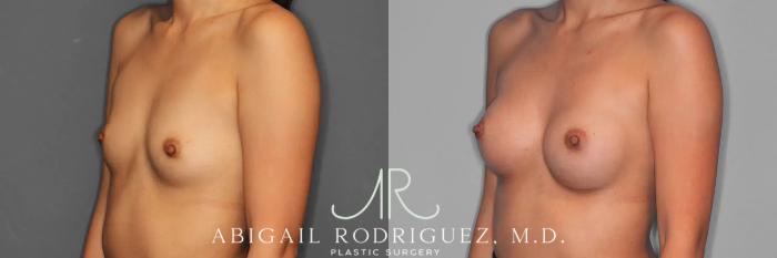 Before & After Breast Augmentation Case 259326 View 3 View in Houston, TX