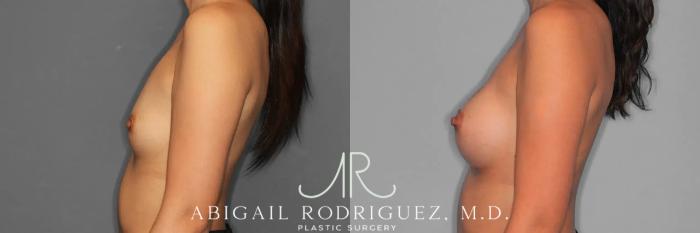Before & After Breast Augmentation Case 259326 View 4 View in Houston, TX