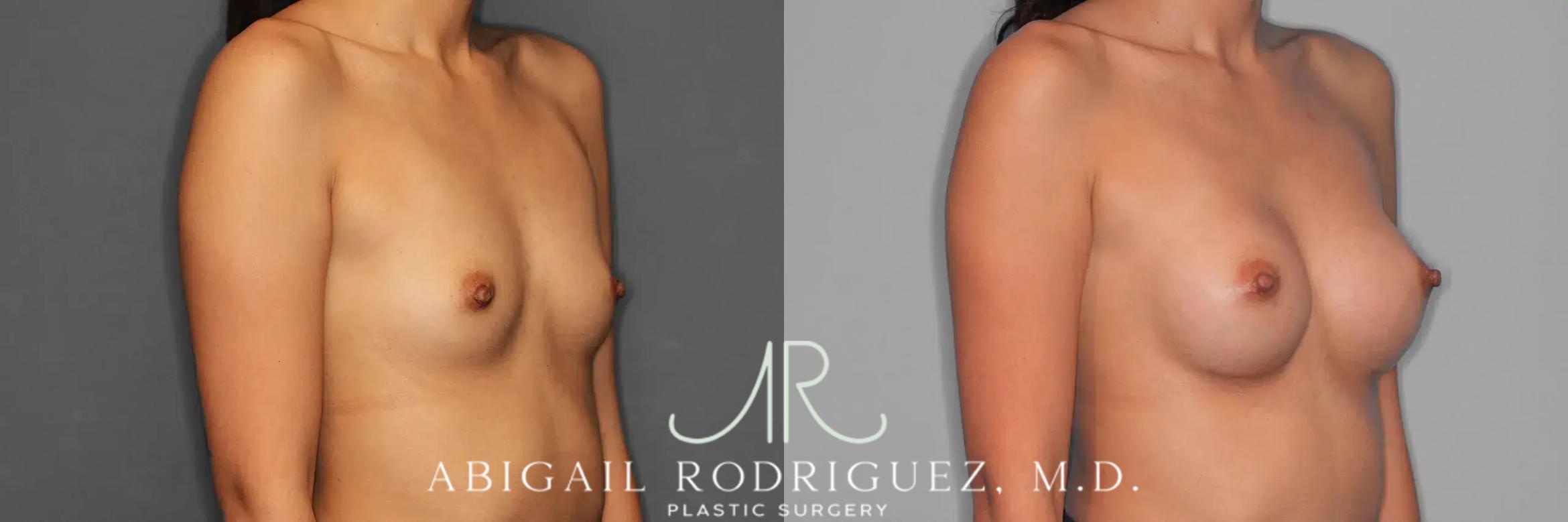 Before & After Breast Augmentation Case 259326 View 5 View in Houston, TX