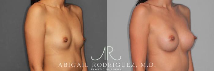Before & After Breast Augmentation Case 259326 View 5 View in Houston, TX