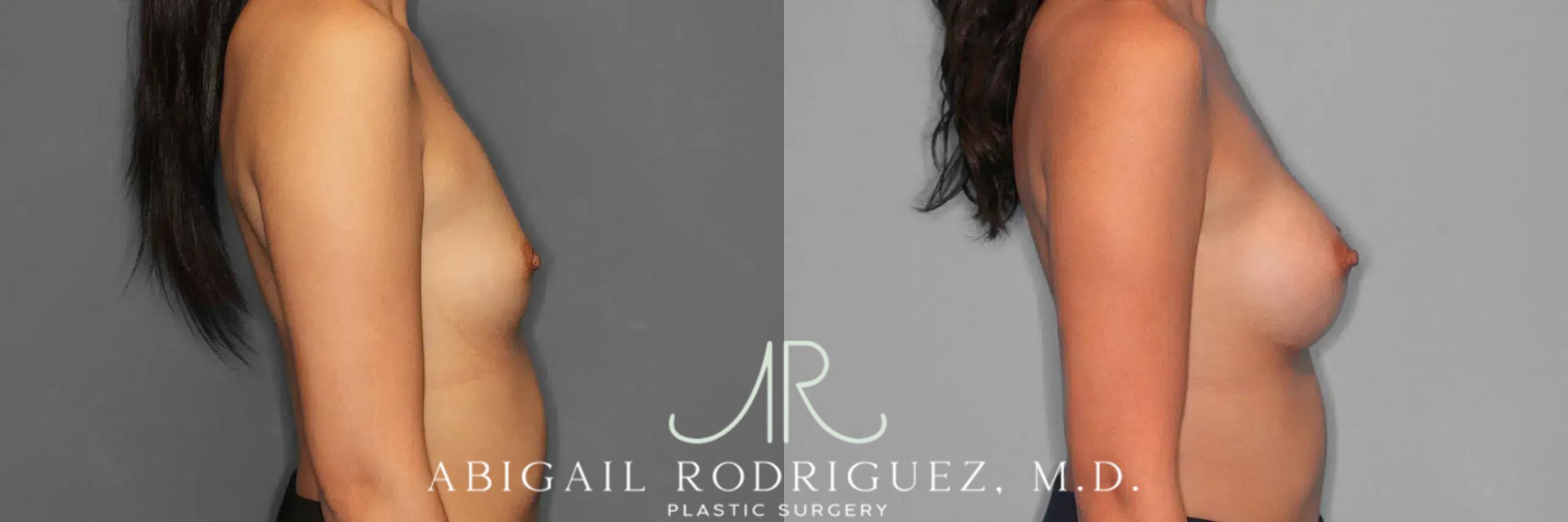 Before & After Breast Augmentation Case 259326 View 6 View in Houston, TX