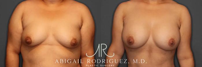 Before & After Breast Augmentation Case 259392 View 1 View in Houston, TX