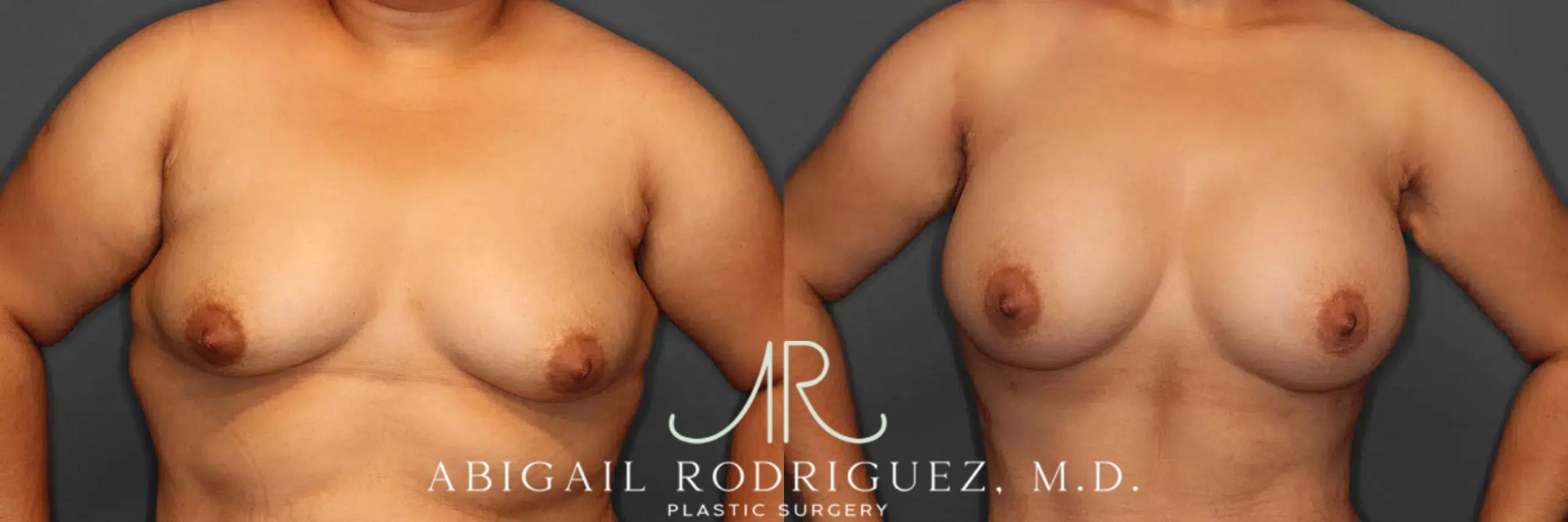 Before & After Breast Augmentation Case 259392 View 2 View in Houston, TX