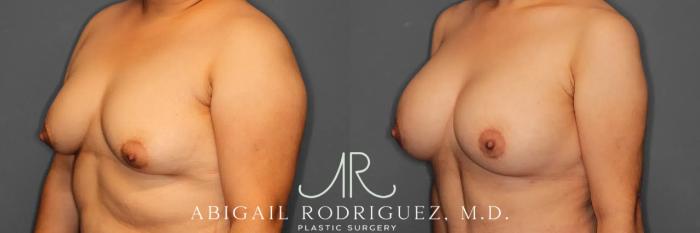 Before & After Breast Augmentation Case 259392 View 3 View in Houston, TX