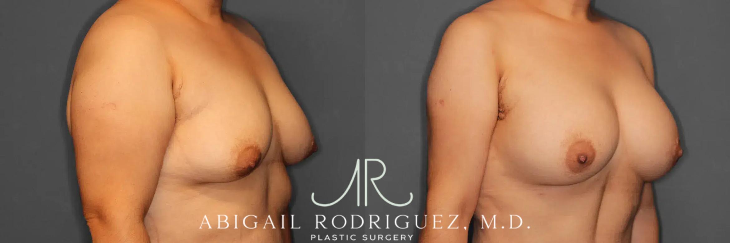 Before & After Breast Augmentation Case 259392 View 5 View in Houston, TX