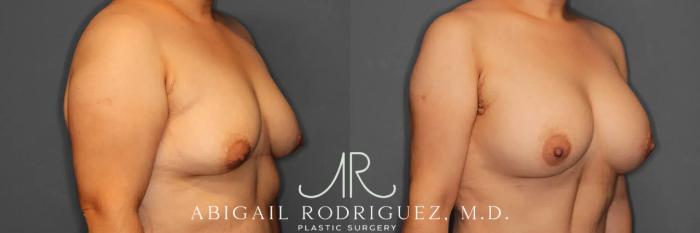 Before & After Breast Augmentation Case 259392 View 5 View in Houston, TX