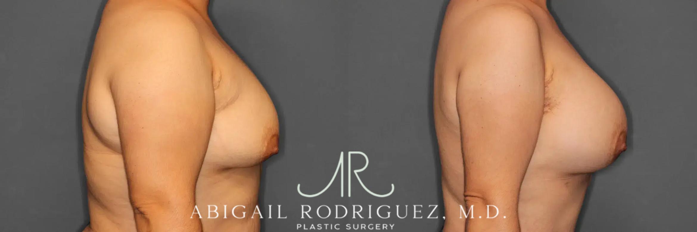 Before & After Breast Augmentation Case 259392 View 6 View in Houston, TX