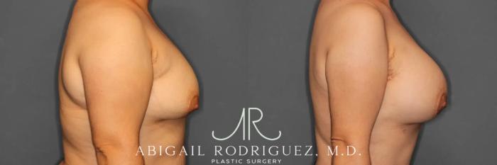 Before & After Breast Augmentation Case 259392 View 6 View in Houston, TX