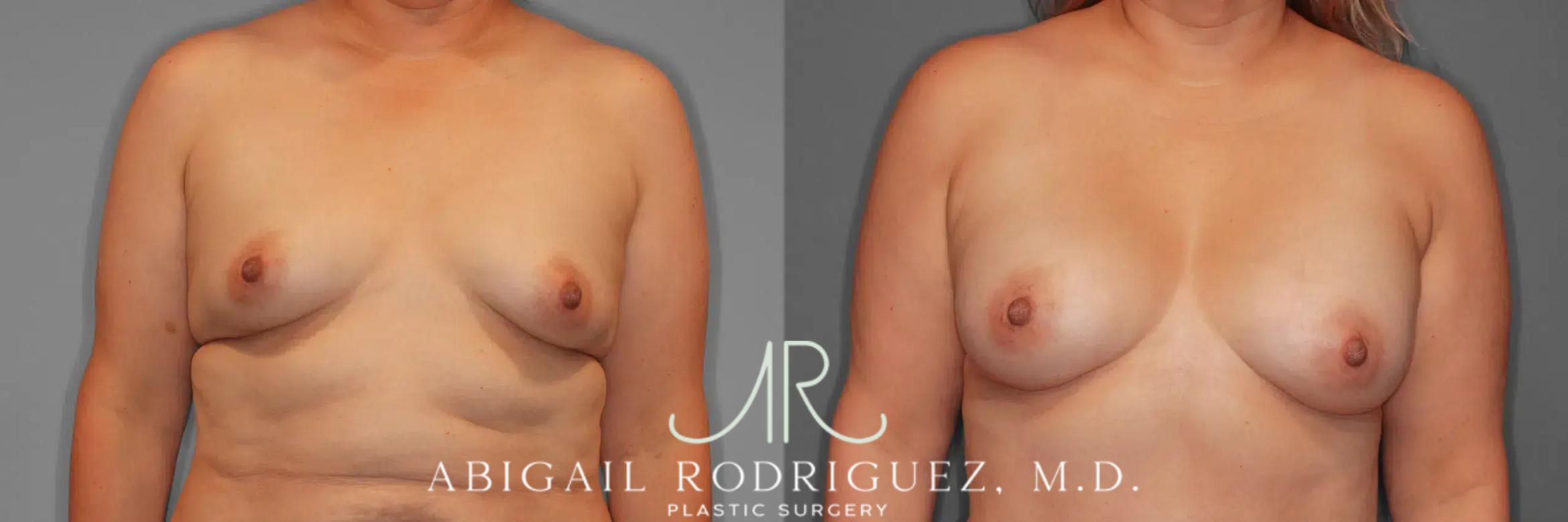Before & After Breast Augmentation Case 259437 View 1 View in Houston, TX
