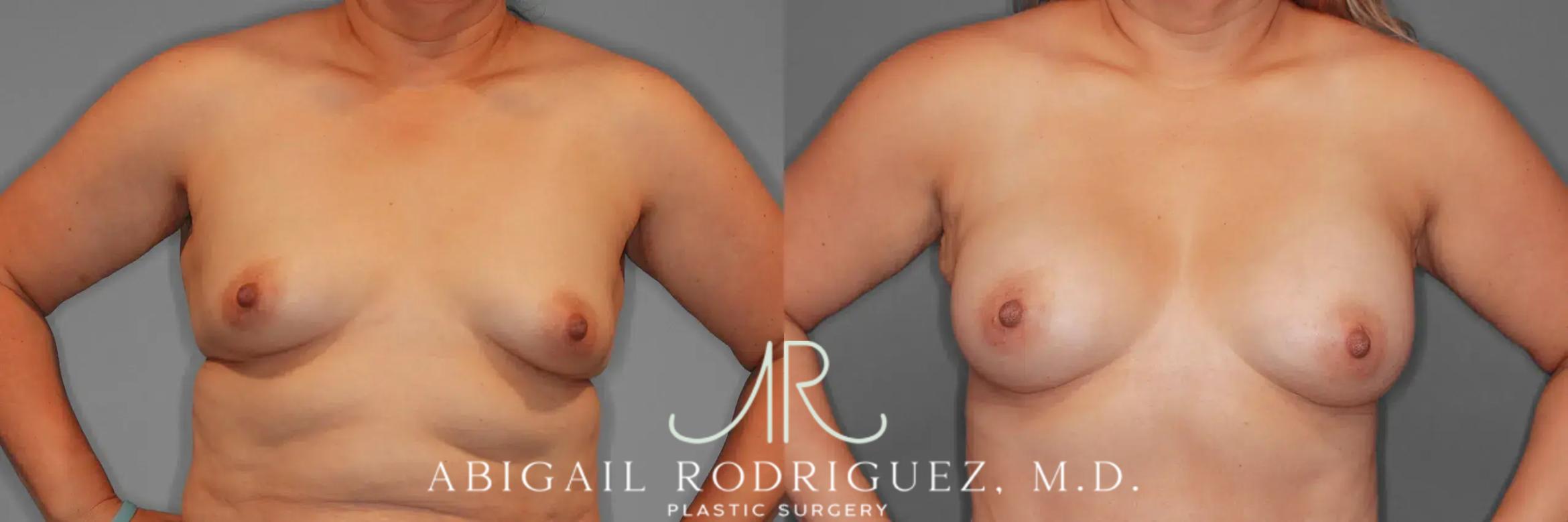 Before & After Breast Augmentation Case 259437 View 2 View in Houston, TX