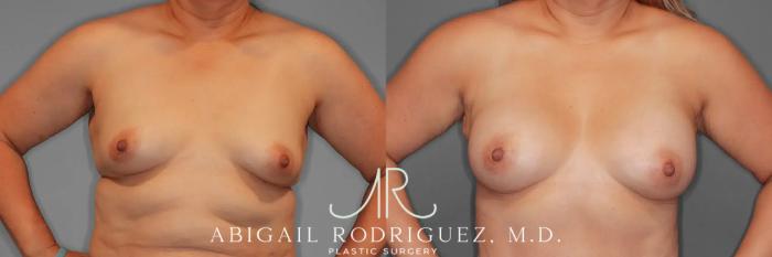 Before & After Breast Augmentation Case 259437 View 2 View in Houston, TX