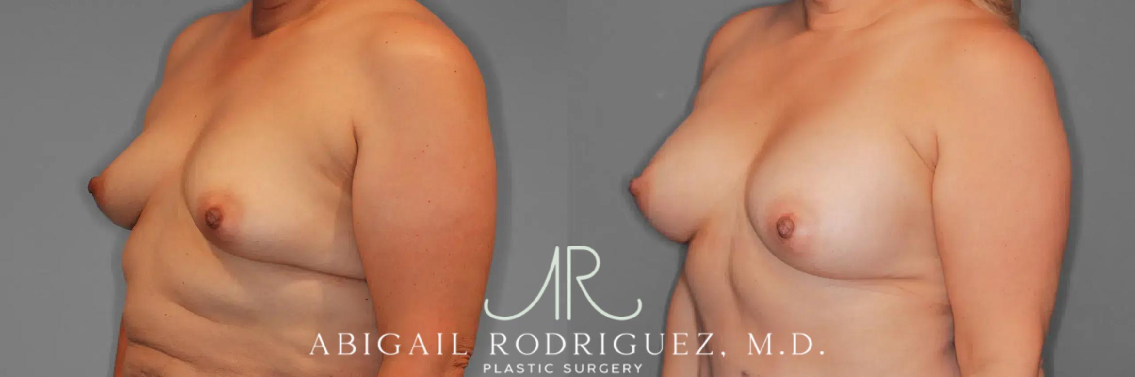 Before & After Breast Augmentation Case 259437 View 3 View in Houston, TX