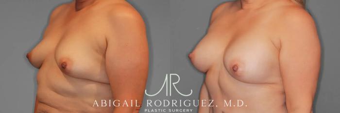 Before & After Breast Augmentation Case 259437 View 3 View in Houston, TX