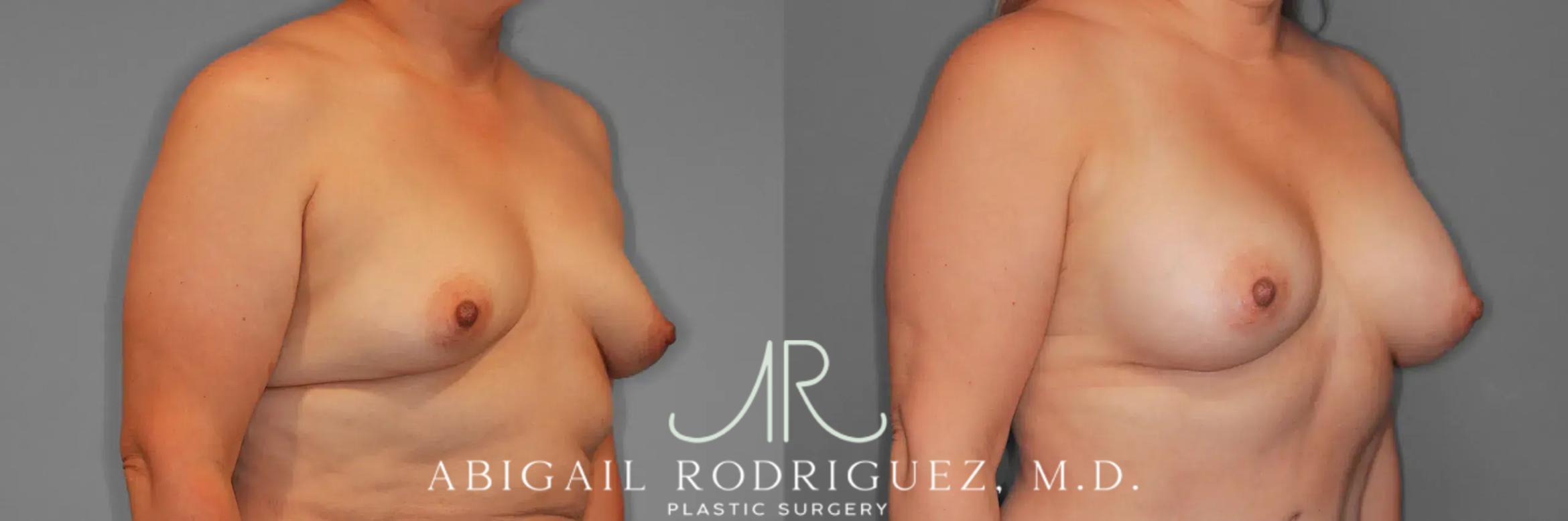 Before & After Breast Augmentation Case 259437 View 5 View in Houston, TX