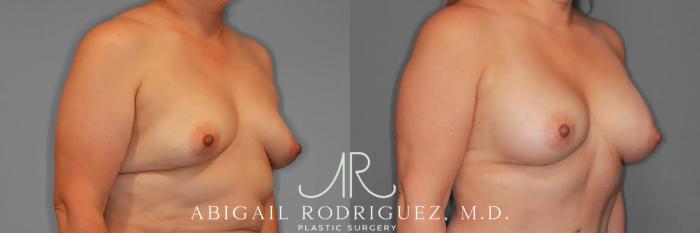 Before & After Breast Augmentation Case 259437 View 5 View in Houston, TX