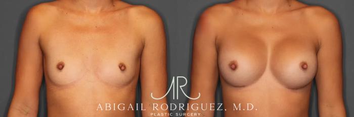 Before & After Breast Augmentation Case 259466 View 1 View in Houston, TX