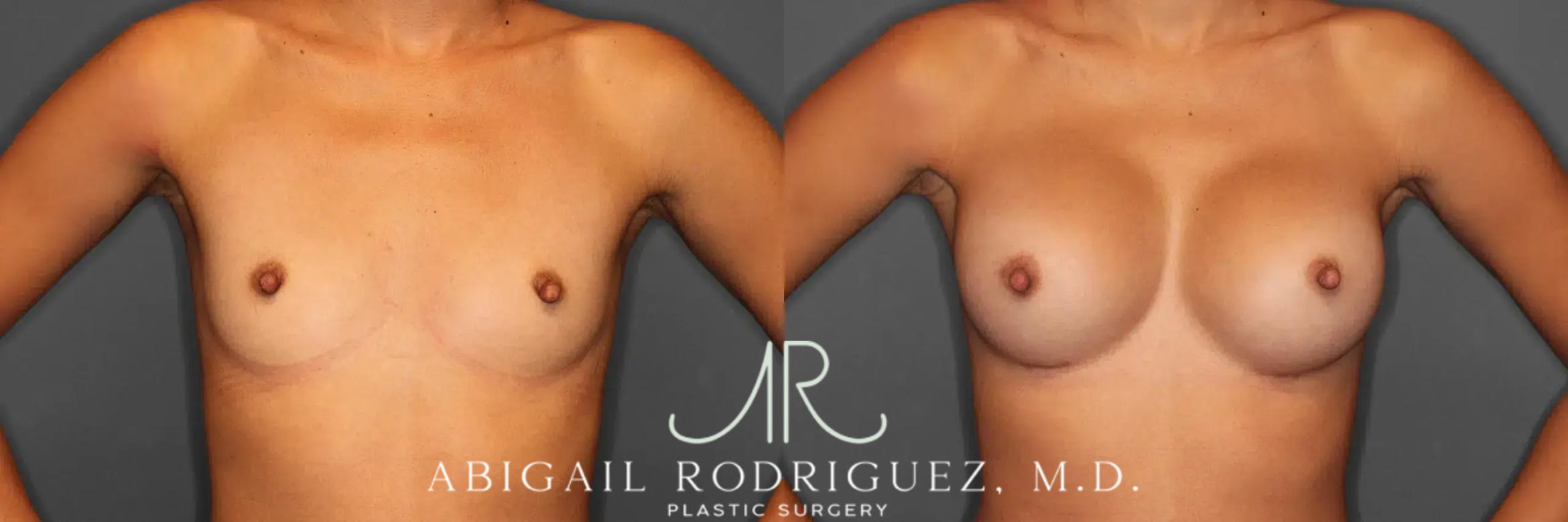 Before & After Breast Augmentation Case 259466 View 2 View in Houston, TX