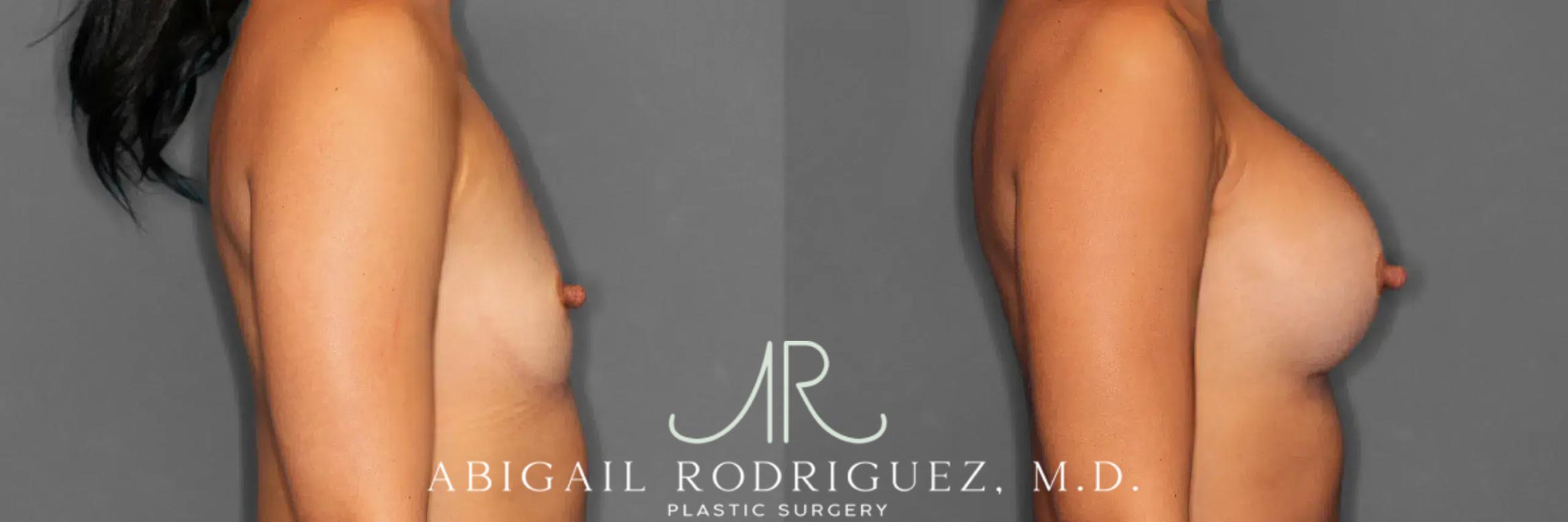 Before & After Breast Augmentation Case 259466 View 5 View in Houston, TX