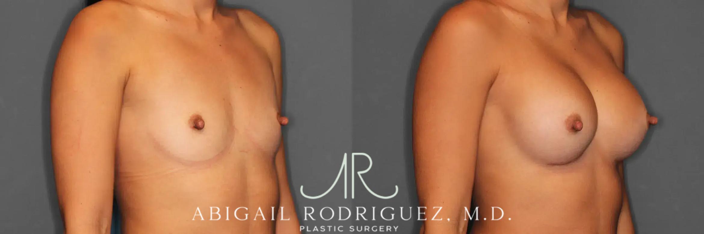 Before & After Breast Augmentation Case 259466 View 6 View in Houston, TX
