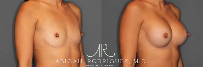 Before & After Breast Augmentation Case 259466 View 6 View in Houston, TX