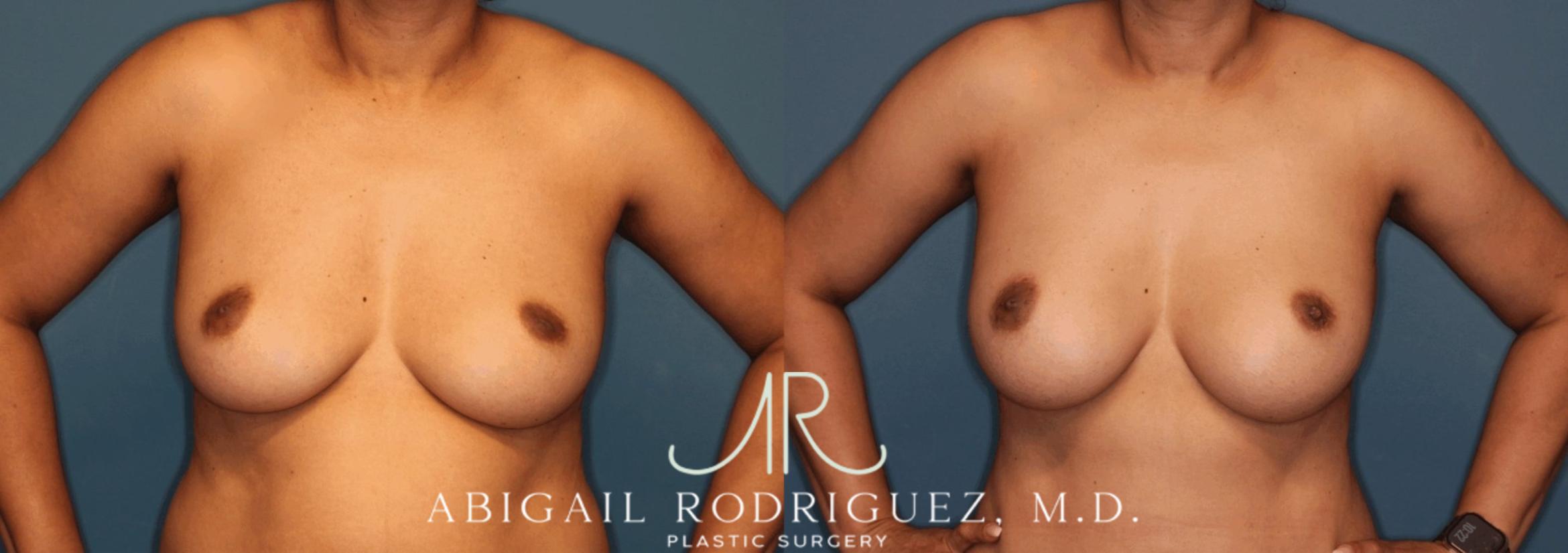 Before & After Breast Augmentation Case 345999 Front Arms Out View in Houston, TX