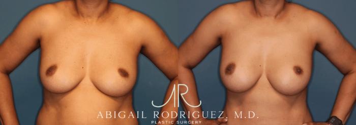 Before & After Breast Augmentation Case 345999 Front Arms Out View in Houston, TX