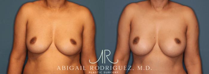 Before & After Breast Augmentation Case 345999 Front View in Houston, TX