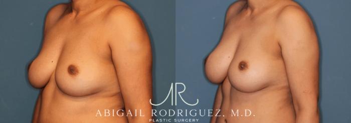 Before & After Breast Augmentation Case 345999 Left Oblique View in Houston, TX