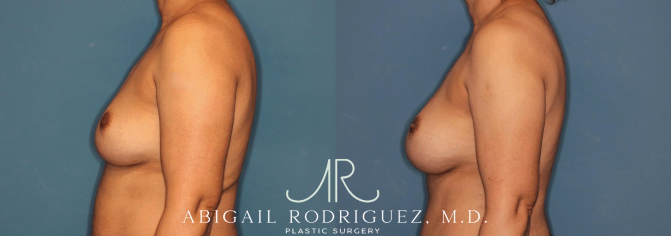 Before & After Breast Augmentation Case 345999 Left Side View in Houston, TX