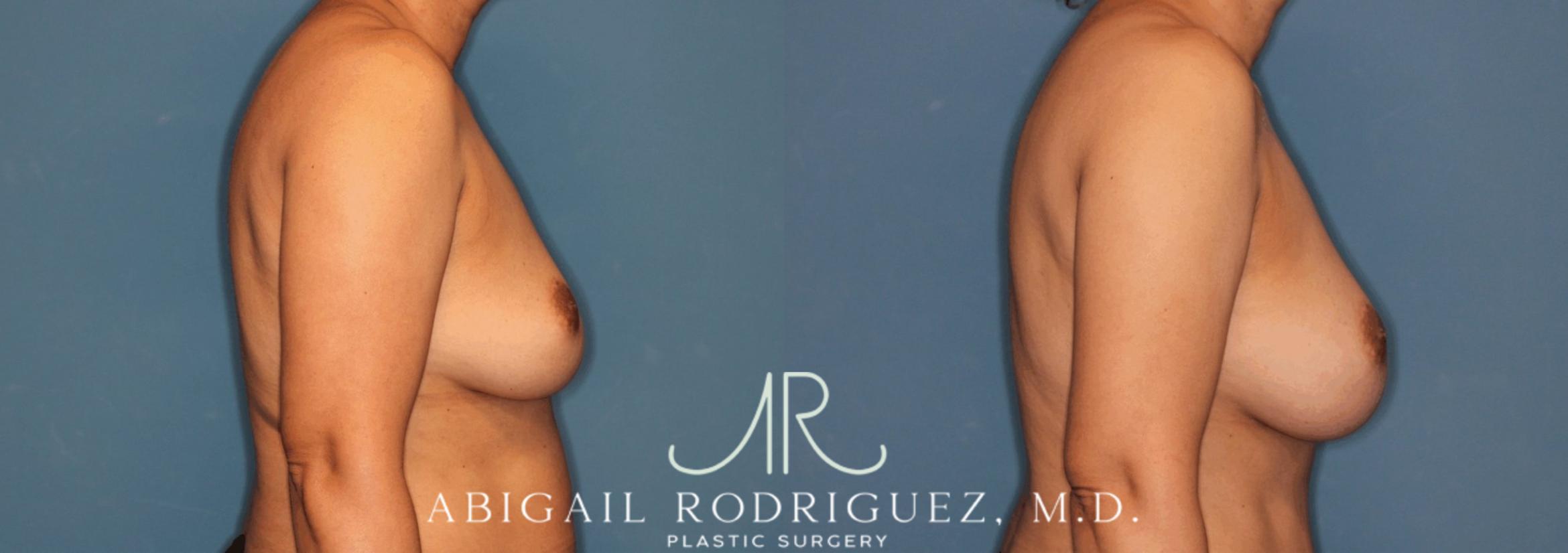 Before & After Breast Augmentation Case 345999 Right Side View in Houston, TX