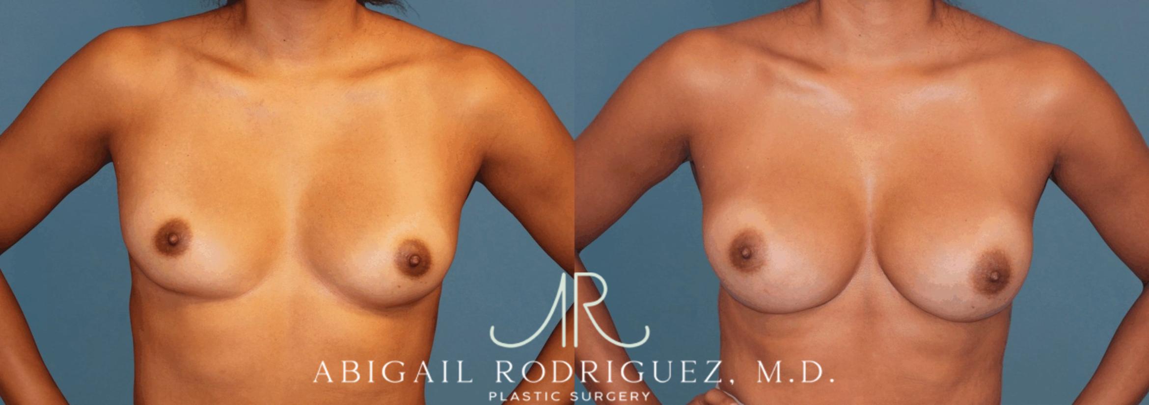 Before & After Breast Augmentation Case 346001 Front Arms Out View in Houston, TX