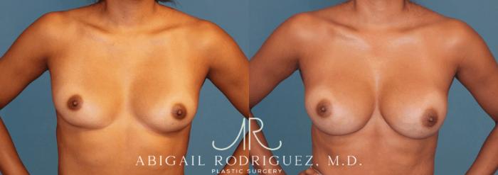 Before & After Breast Augmentation Case 346001 Front Arms Out View in Houston, TX