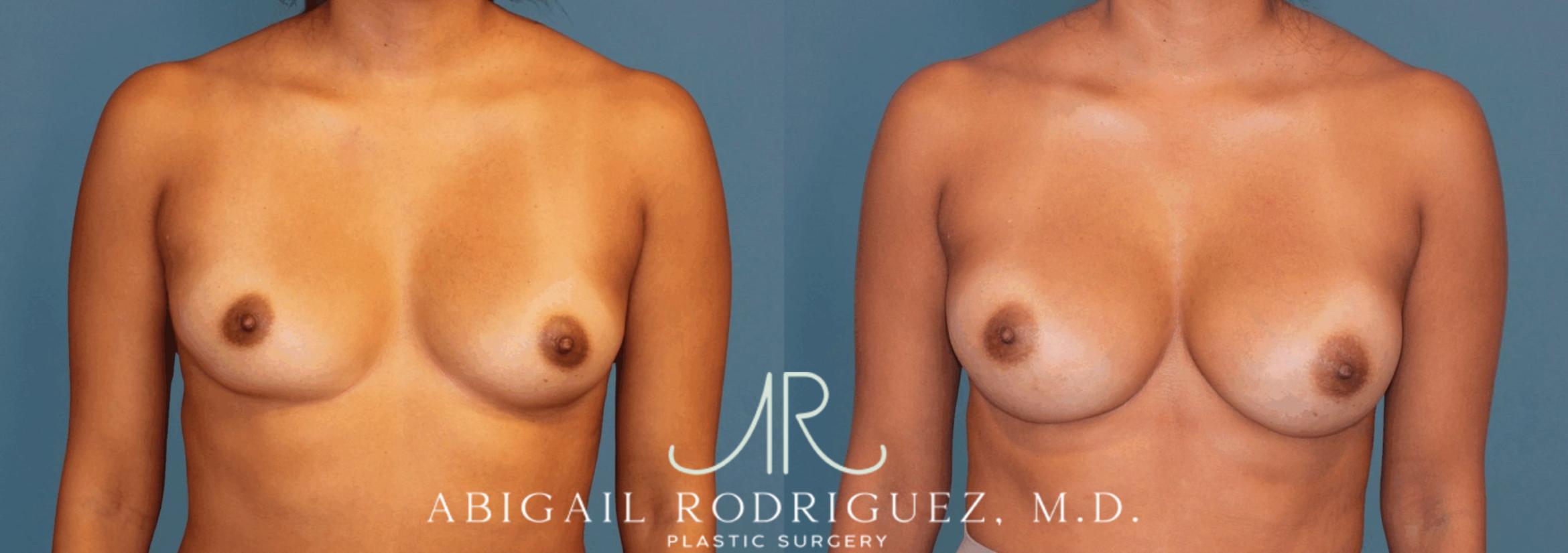 Before & After Breast Augmentation Case 346001 Front View in Houston, TX