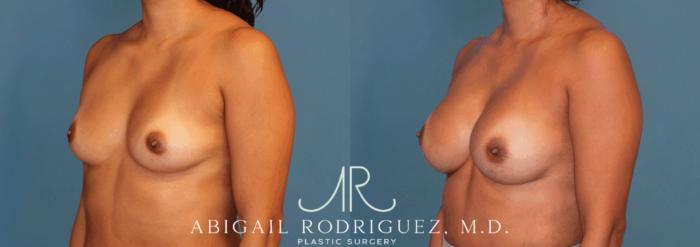 Before & After Breast Augmentation Case 346001 Left Oblique View in Houston, TX