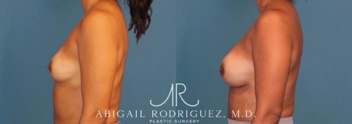Before & After Breast Augmentation Case 346001 Left Side View in Houston, TX
