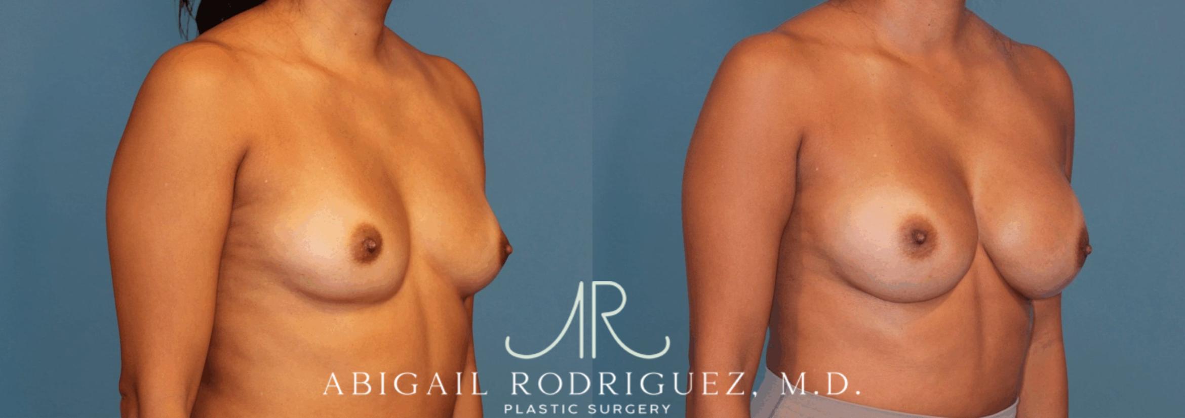 Before & After Breast Augmentation Case 346001 Right Oblique View in Houston, TX