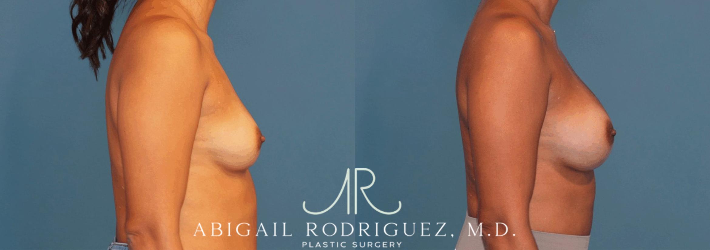 Before & After Breast Augmentation Case 346001 Right Side View in Houston, TX