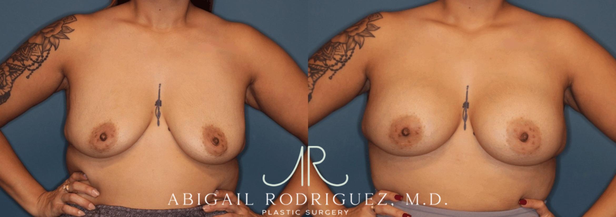 Before & After Breast Augmentation Case 346002 Front Arms Out View in Houston, TX