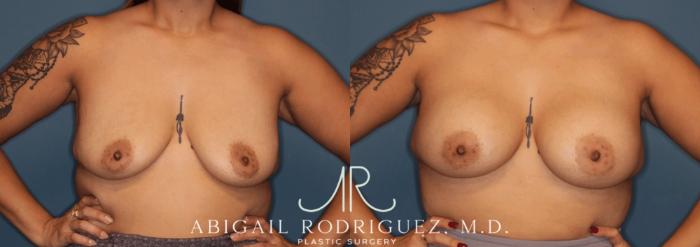 Before & After Breast Augmentation Case 346002 Front Arms Out View in Houston, TX