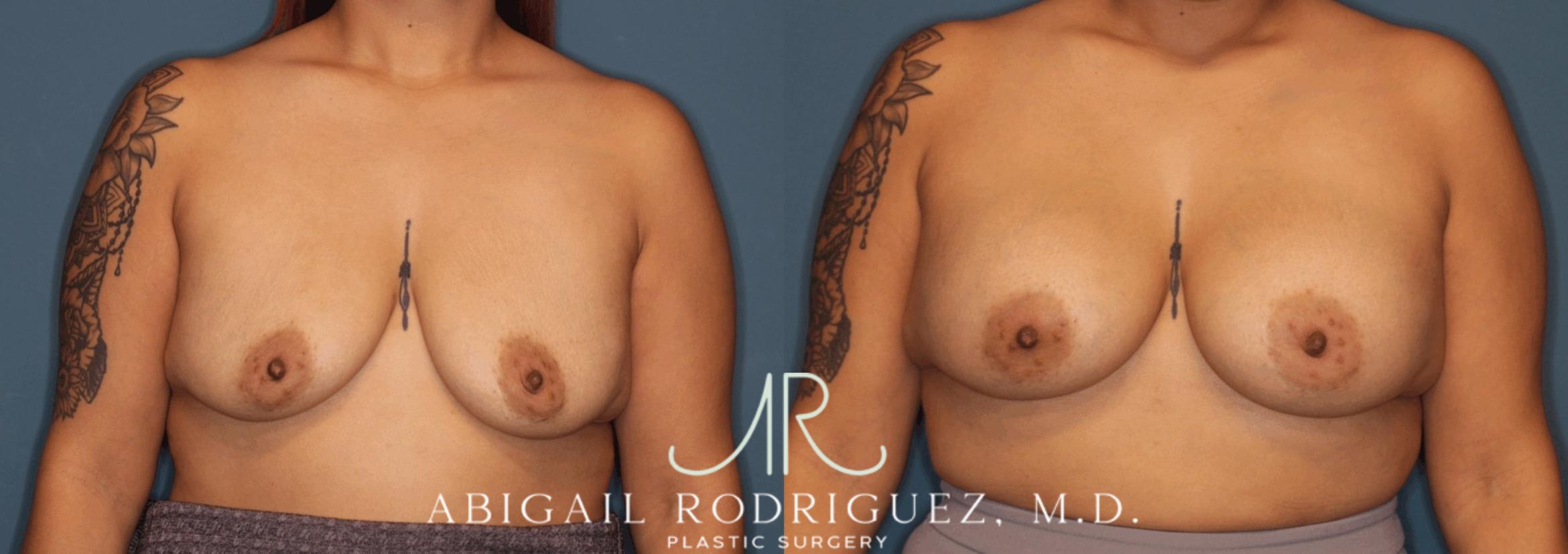 Before & After Breast Augmentation Case 346002 Front View in Houston, TX