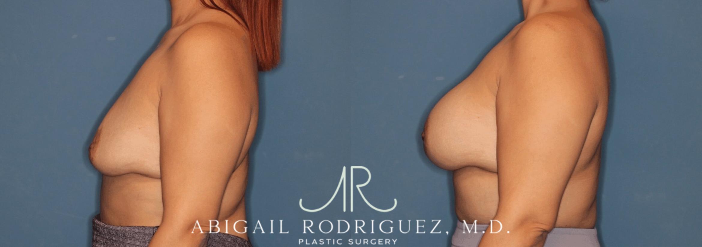 Before & After Breast Augmentation Case 346002 Left Side View in Houston, TX