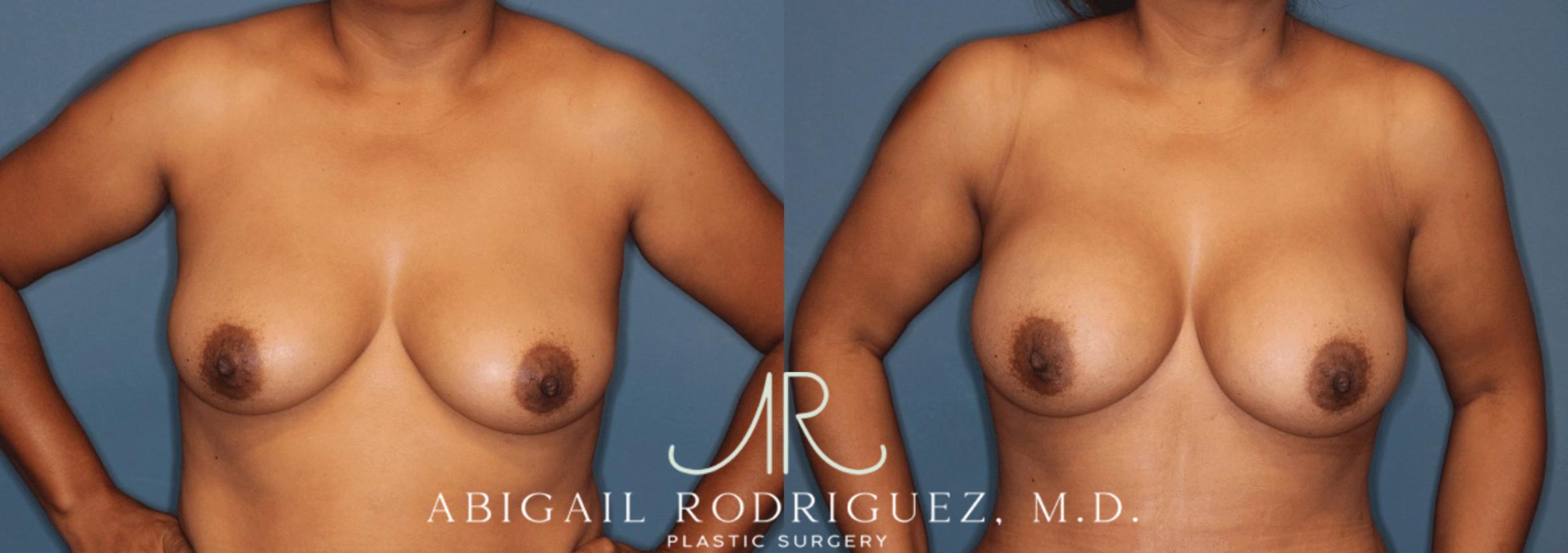 Before & After Breast Augmentation Case 346003 Front Arms Out View in Houston, TX