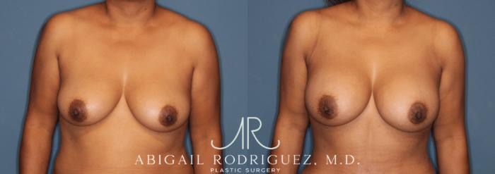 Before & After Breast Augmentation Case 346003 Front View in Houston, TX
