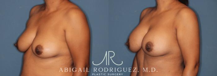 Before & After Breast Augmentation Case 346003 Left Oblique View in Houston, TX